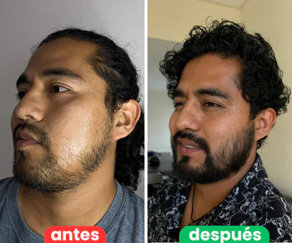 Bálsamo para Crecimiento de Barba Ultra Potente con Minoxidil 20% | 100mL 😍