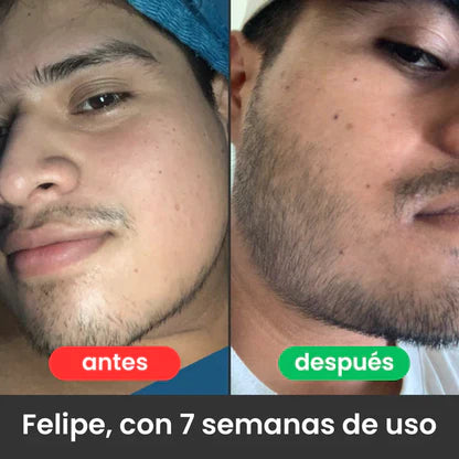 Bálsamo para Crecimiento de Barba Ultra Potente con Minoxidil 20% | 100mL 😍